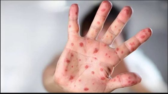 تسجيل أول حالة وفاة بـ”جدري ألاسكا”