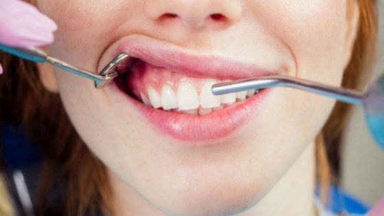 أمراض اللثة تزيد مخاطر الإصابة بالزهايمر