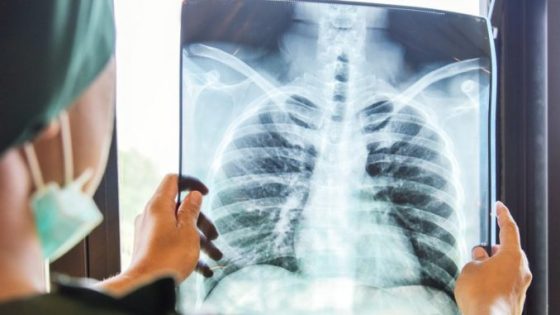 وزارة الصحة والحماية الاجتماعية تخلد اليوم العالمي لمحاربة داء السل