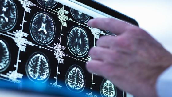 دراسة حديثة تكشف عن علاقة الصحة النفسية بتقليل خطر فقدان الذاكرة