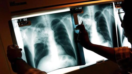 منظمة الصحة: مرض السل حصد 1,23 مليون شخص العام الماضي